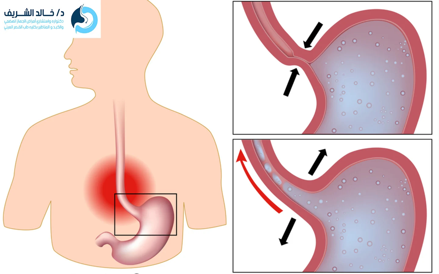علاج ارتجاع المريء نهائيا