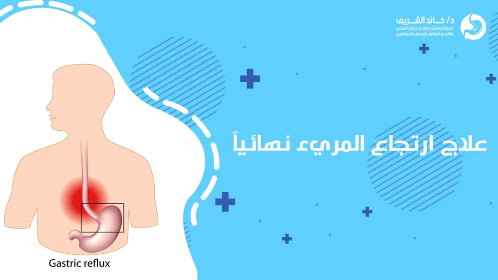 علاج ارتجاع المريء نهائياً
