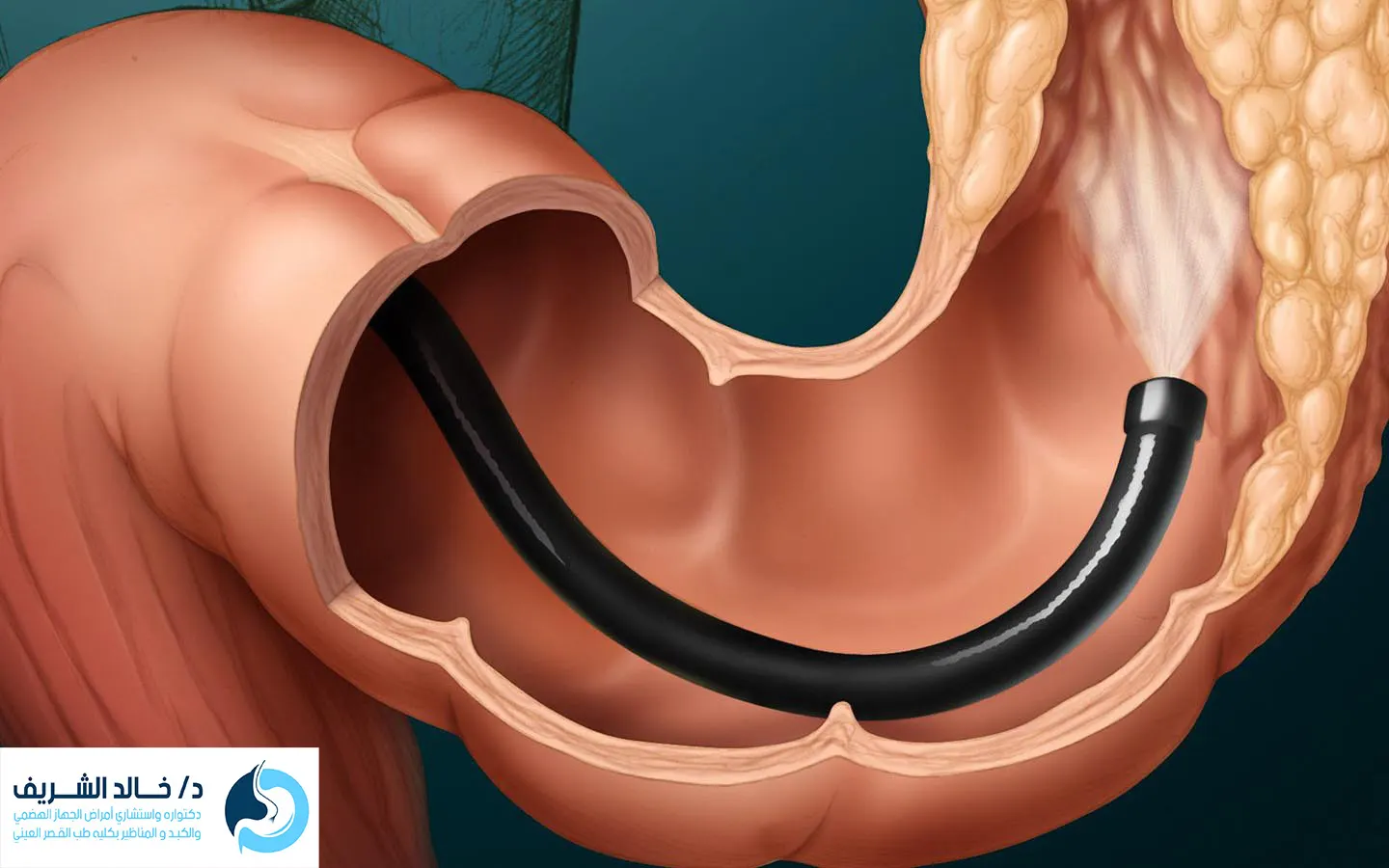 منظار القولون