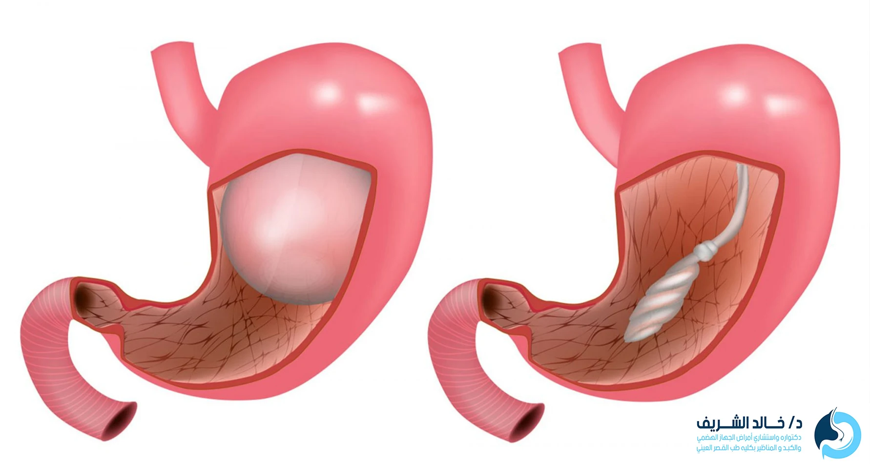 الكبسولة الذكية