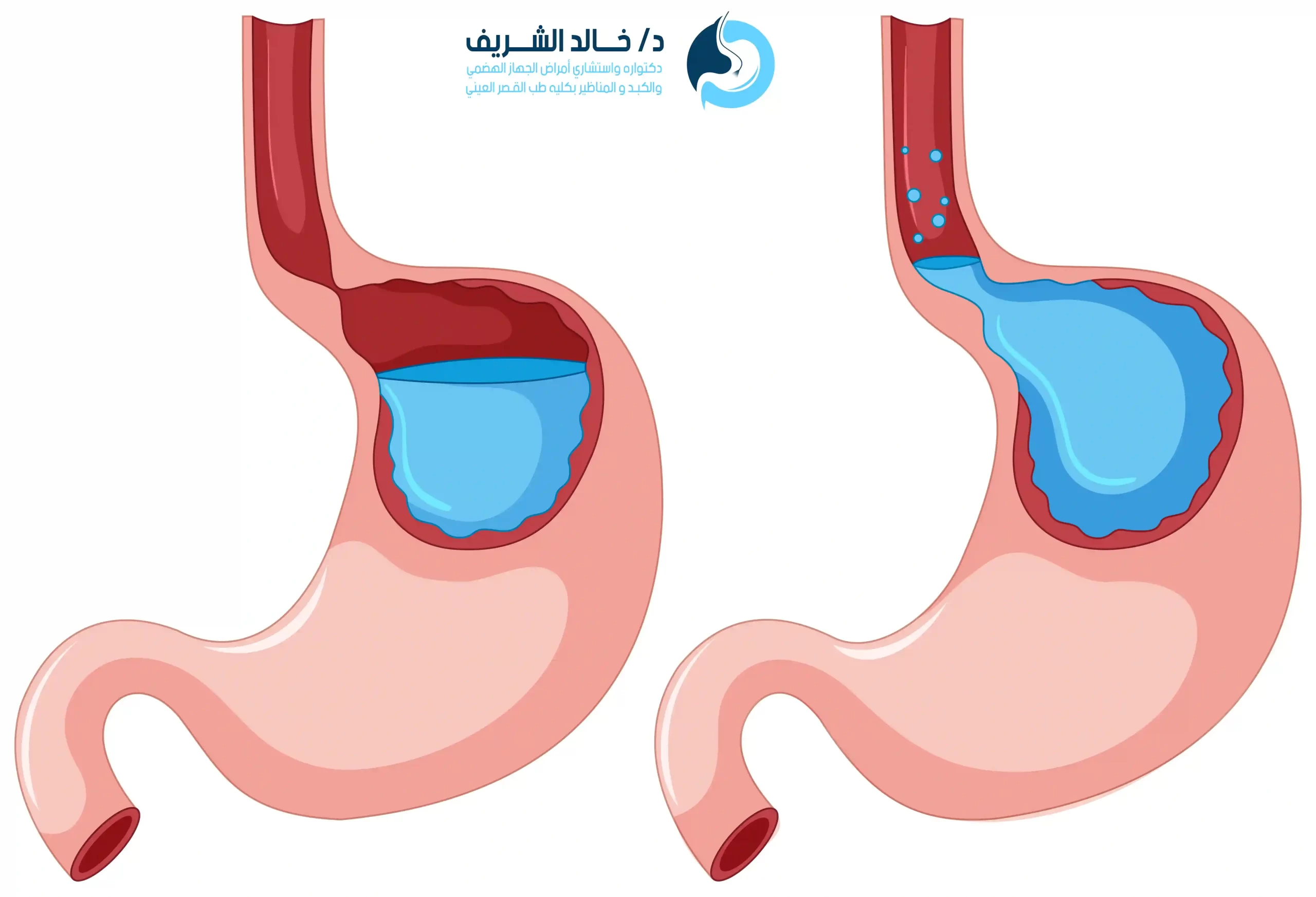 تكلفة عملية ارتجاع المرئ فى مصر