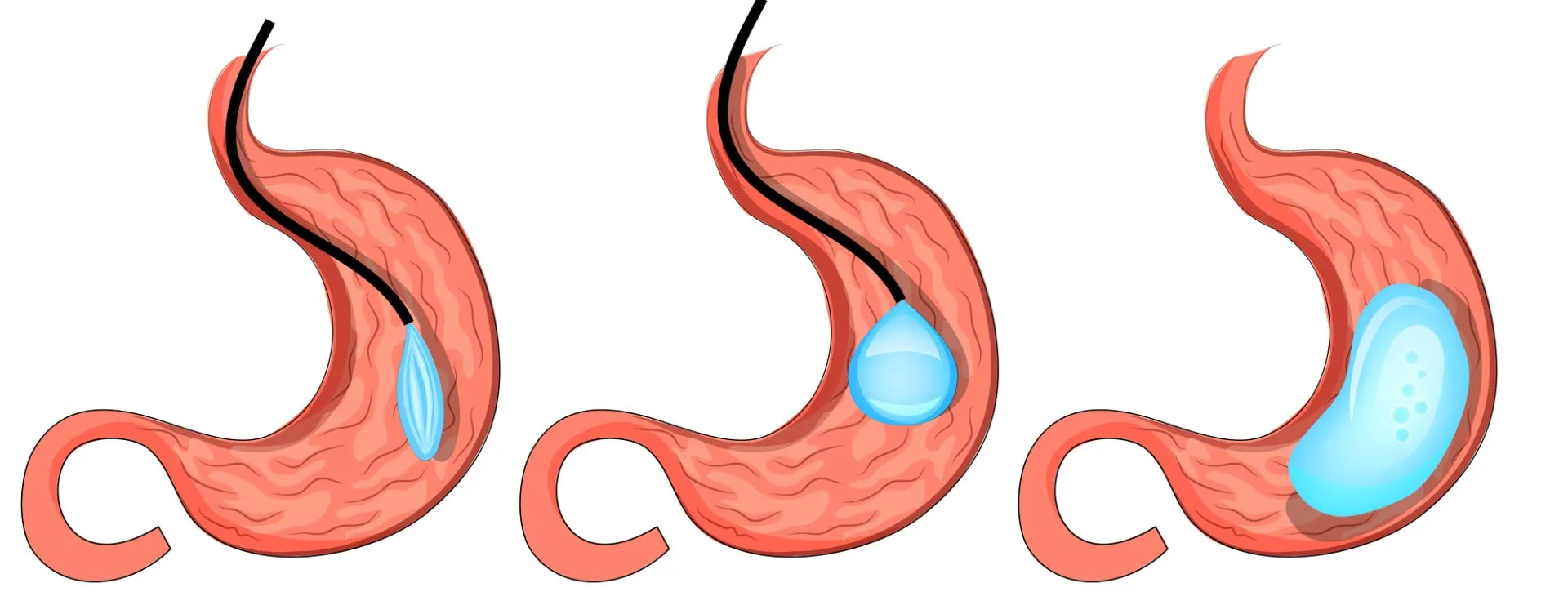 سعر عملية بالون المعدة للتخسيس في مصر