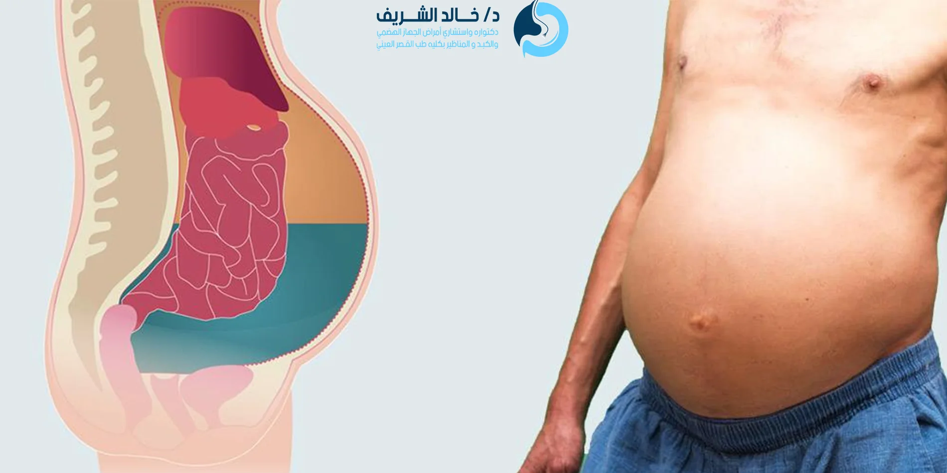 شكل بطن مريض الكبد