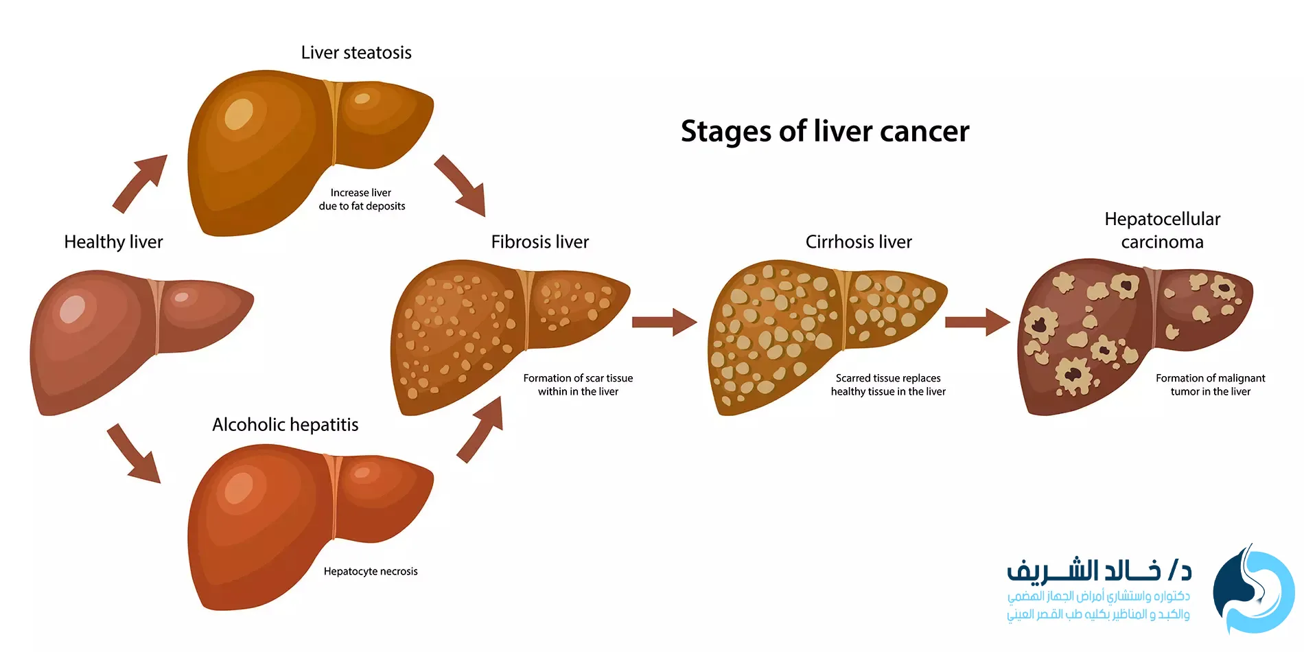 هل تليف الكبد يسبب الوفاة 