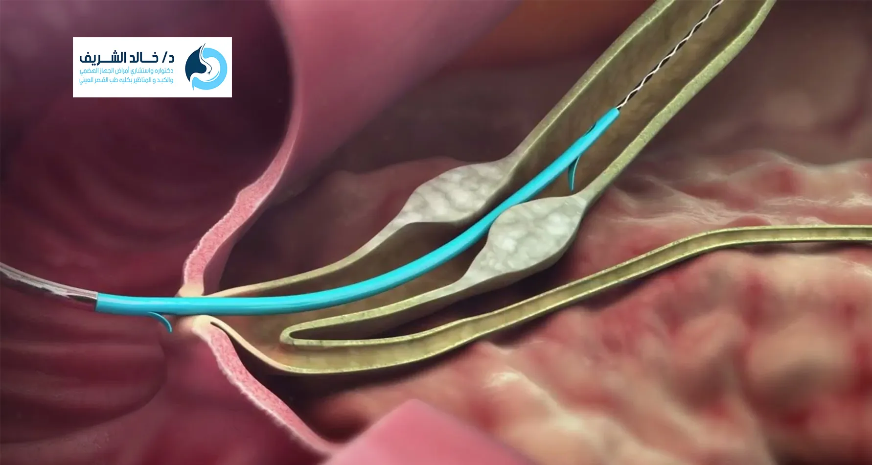 Stent plastic - شكل دعامة المرارة البلاستيكية