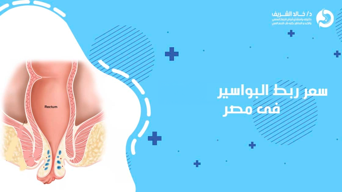 تكلفة ربط البواسير فى مصر