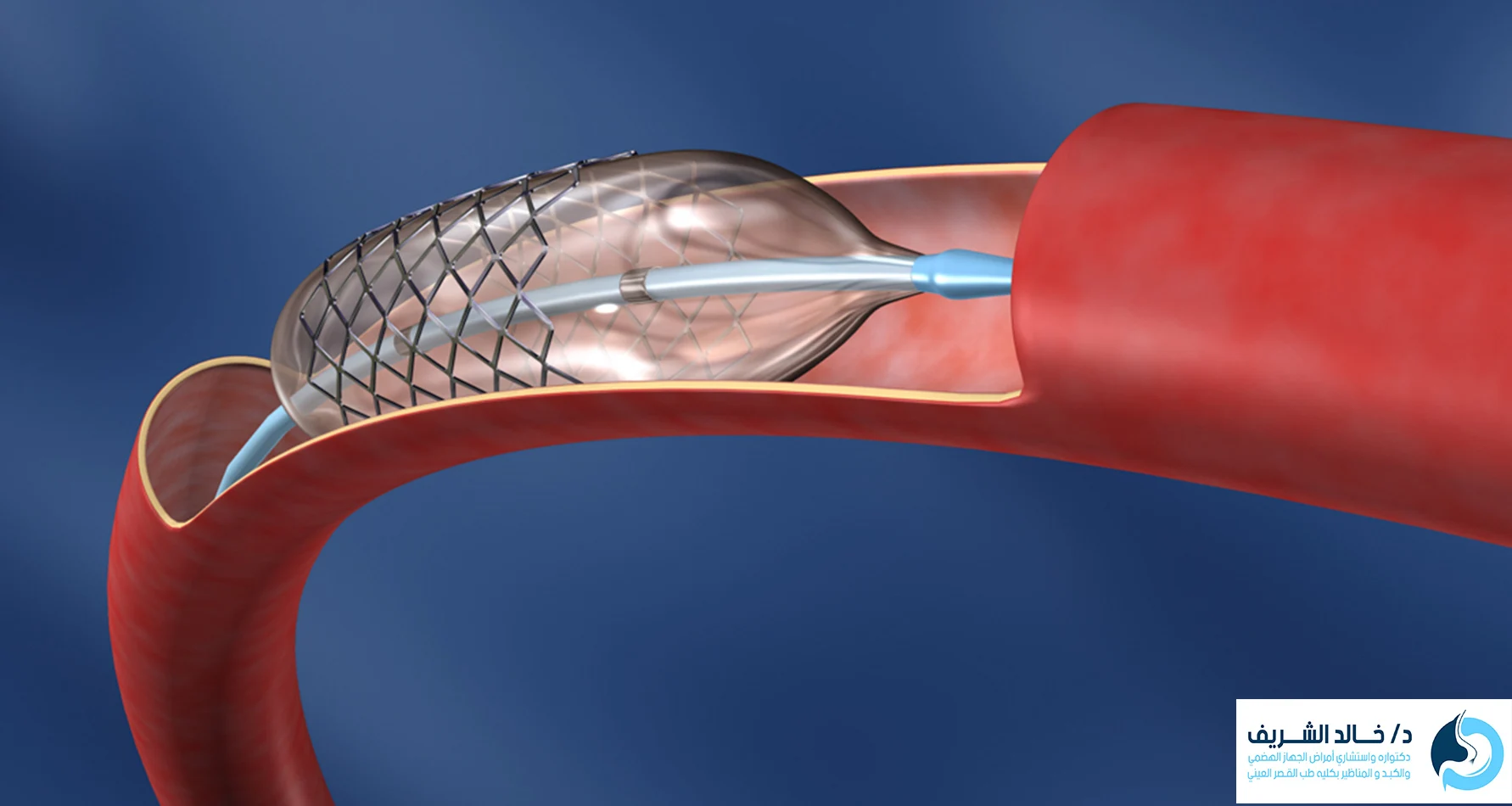 شكل دعامة المرارة
