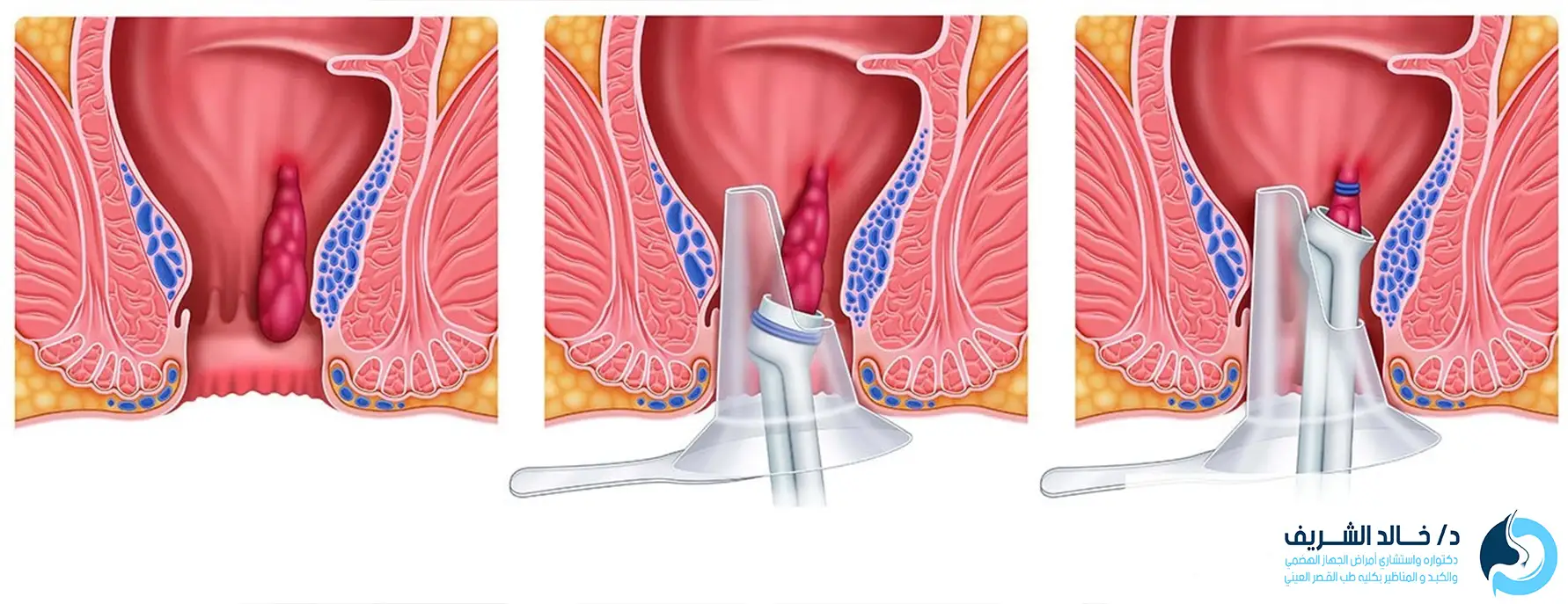 عملية ربط البواسير
