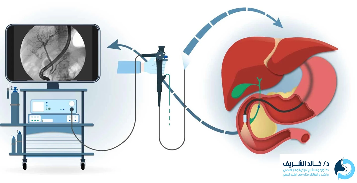 منظار القنوات المرارية
