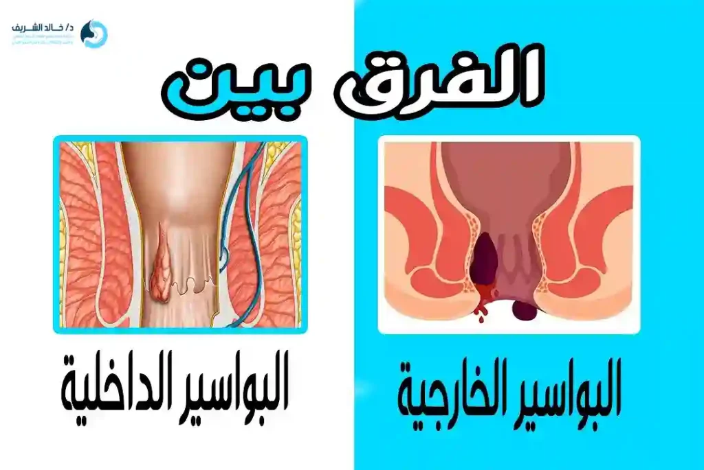 الفرق بين البواسير الداخليه والخارجيه