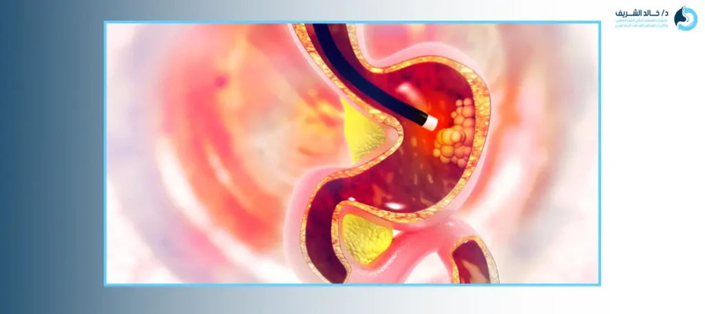 ازالة الحصوات من القناة الصفراوية بالمنظار بدون جراحة