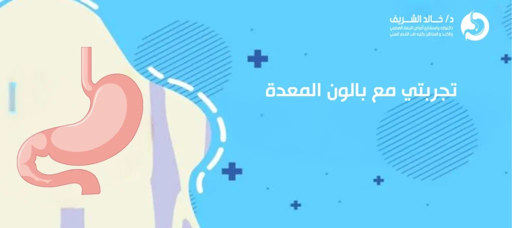 تجربتي مع بالون المعدة
