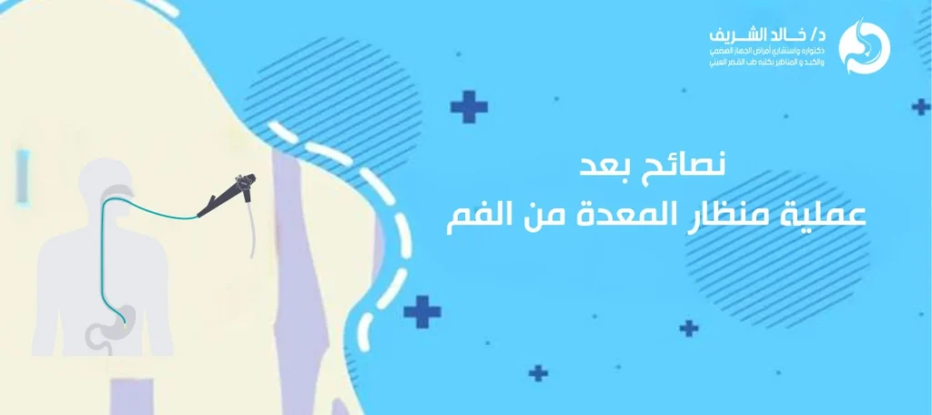 نصائح بعد عملية منظار المعدة من الفم
