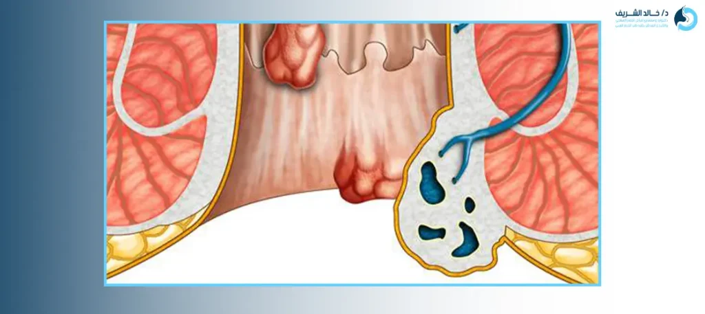 اعراض البواسير الداخلية من الدرجة الاولى
