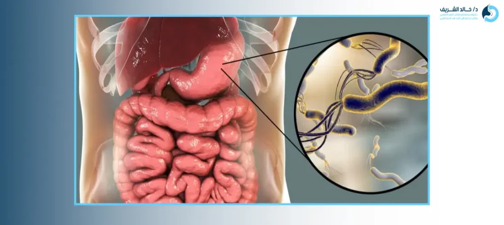 اعراض جرثومة المعدة