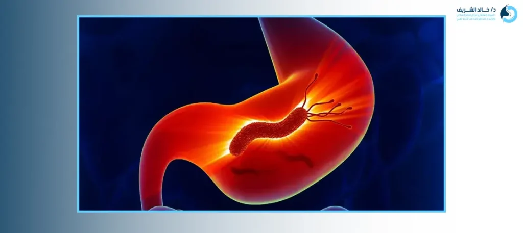 اعراض جرثومة المعده والقولون